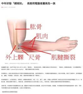 [2022-11-24]  - 中年好發「網球肘」　長期用電腦者屬高危一族